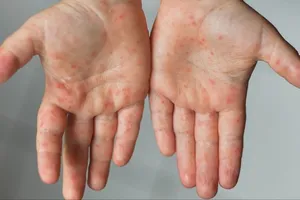 Có 170 ca mắc bệnh tay chân miệng ở Quảng Ngãi