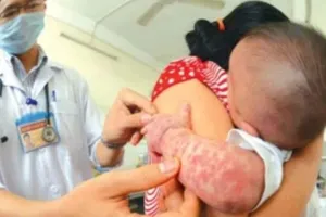 TPHCM: Thêm 23 phường, xã hết dịch sởi