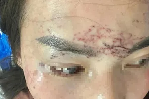 Khởi tố vụ đánh ghen xăm lên mặt, tạt axit gây xôn xao ở Cà Mau