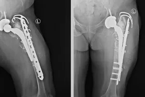 Lần đầu ở miền Trung - Tây Nguyên thay khớp háng và xương đùi bằng Megaprosthesis 