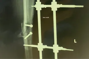 Phẫu thuật thành công cho bệnh nhi bị tai nạn giao thông