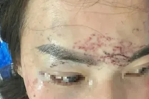 Truy tố chủ cơ sở thẩm mỹ xăm mặt “tình địch”