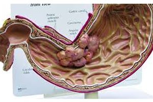 Over 11,000 stomach cancer-related deaths recorded in Vietnam annually