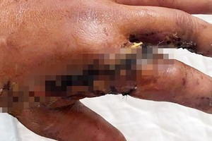 Surgeons reattach amputated forefinger, thumb