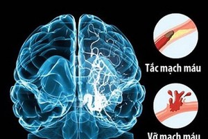 Over 10,000 have stroke in Mekong delta annually  ​