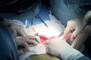 Renal transplant on kid from brain-dead donor for first time