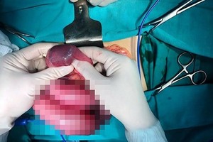 Young man has tapioca beads in intestine because of often drinking milk tea