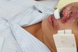 Four people die of rare Whitmore’s disease in North Vietnam