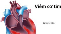 Medical expert denies rumor about viral causes of human myocarditis