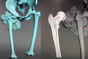 Vietnamese surgeons use 3D printing to make replacement bones