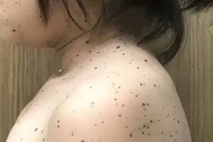 First case of Noonan syndrome discovered in Vietnam