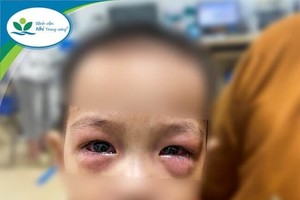 Neonatal tetanus, viral conjunctivitis reported 