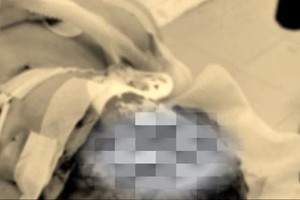 Surgeons save girl who has scalp peeled off after work accident