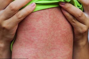 New school year fast approaches, risk of measles outbreak higher: Ministry