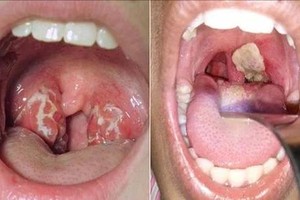 Thanh Hoa suggests supply of 25,000 doses of tetanus-diphtheria vaccine