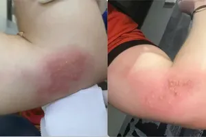 Healthy young Canadian develops severe shingles complication in HCMC