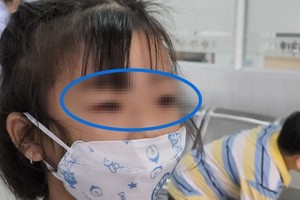 Enterovirus, adenovirus identified as cause of pink eye in HCMC