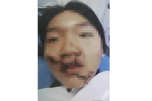 Khuôn mặt biến dạng của bé T.,