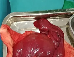 Hình chụp CT scan cho thấy khối u chiếm gần toàn bộ ổ bụng, từ vùng chậu lên đến sát gan​