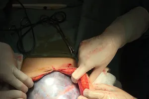 Hình ảnh khối u trong bụng bệnh nhân