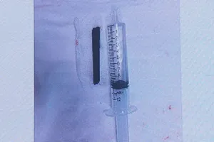 Đoạn đũa dài 7cm được lấy ra thành công