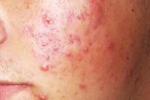 Mất tiền, mang tật vì sử dụng tế bào gốc làm đẹp