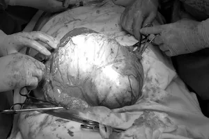 Ung thư buồng trứng giai đoạn muộn vì chủ quan