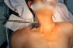 Cứu sống kịp thời công nhân bị thanh sắt đâm xuyên cổ
