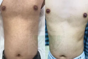 Phát hiện bệnh lý lây truyền qua đường tình dục hiếm gặp