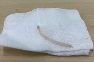 Xương cá được lấy ra khỏi thanh môn của bệnh nhân