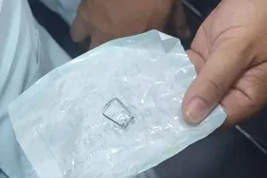 Dị vật là lò xo 2 càng nhọn trong thành họng bé trai 3 tuổi