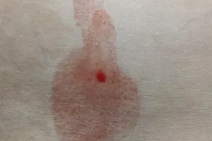 Phát hiện một trường hợp bị “mồ hôi máu” hiếm gặp