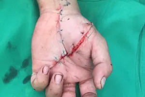 Nối bàn tay bị đứt lìa ngay trong đêm cho bệnh nhân