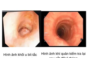Coi chừng bít tắc khí quản do polyp 