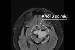 Khối u sọ hầu trong não bệnh nhân