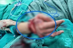 Bác sĩ đang thăm khám cho bệnh nhân sau phẫu thuật vi phẫu nối bàn tay đứt lìa