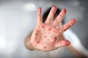 18/20 ca mắc đậu mùa khỉ đang điều trị tại TPHCM nhiễm HIV 