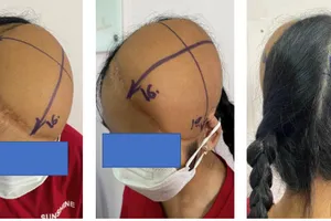 Hình ảnh tóc bệnh nhân mọc qua các quá trình điều trị