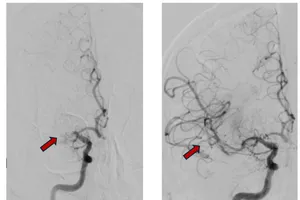 Cứu sống bệnh nhân người Nga bị đột quỵ cấp
