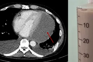Hình chụp CT lồng ngực xác chẩn với mũi tên đỏ thể hiện lớp dịch mủ chèn ép tim và dịch mủ đặc rút ra được qua chọc dịch màng ngoài tim