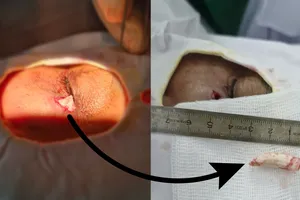 Dị vật được lấy ra là một chiếc cựa gà dài 2.8cm, sắc nhọn