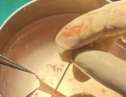 Tạo hình niệu đạo bằng mảnh niêm mạc miệng