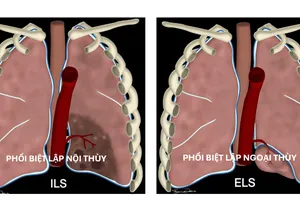 Minh hoạ phổi biệt lập nội thùy và ngoại thùy