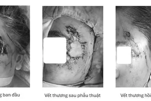 Vùng mặt của người bệnh trước và sau ghép da