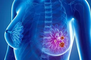 Tỷ lệ ung thư vú ở Việt Nam thấp nhưng tỷ lệ tử vong cao