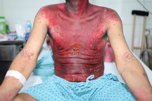 Những ngày đầu nhập viện, người bệnh bị hoại tử thượng bì nhiễm độc nặng (Ảnh: BVCC)
