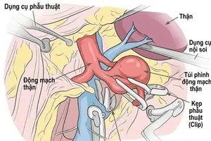 Lược đồ minh hoạ phẫu thuật nội soi kẹp túi phình động mạch thận (Ảnh: BVCC)
