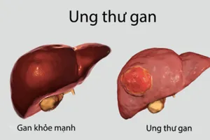 Mỗi năm có khoảng 25.000 ca tử vong do ung thư gan