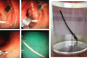 Tăm tre được  nội soi cấp cứu gắp ra ngoài kịp thời