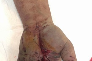 病人其左手掌受了重傷。（圖源：互聯網）